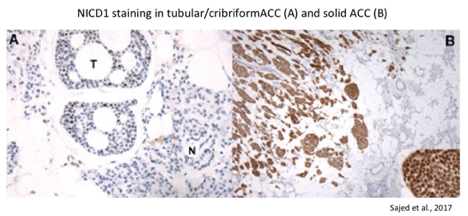 NICD1 staining in tubular/cribirformACC (A) and solid ACC (B)